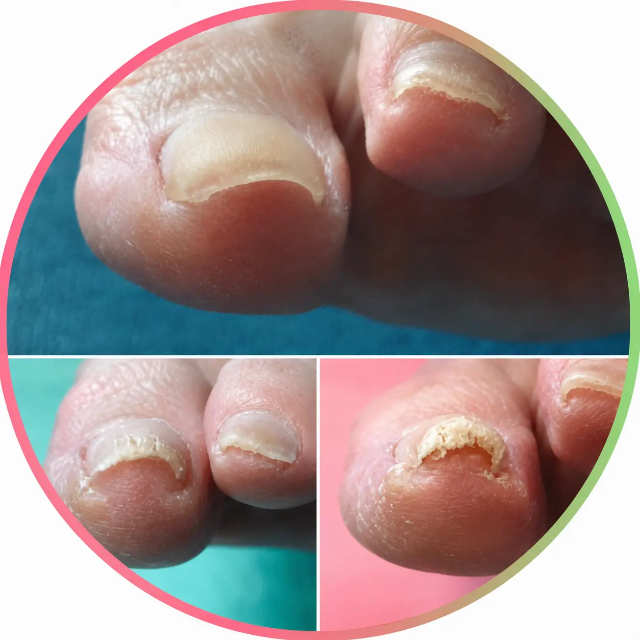 Webinar Ingegroeide- en tunnelnagels