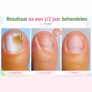 Webinar Mycose