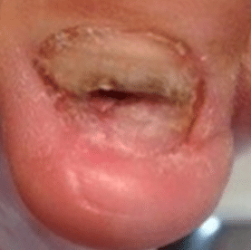 Webinar Stoot- en traumanagels. - Afbeelding 2