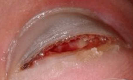 Webinar Stoot- en traumanagels. - Afbeelding 4